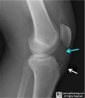 osgood schlatter disease and how itbandz stops this knee pain